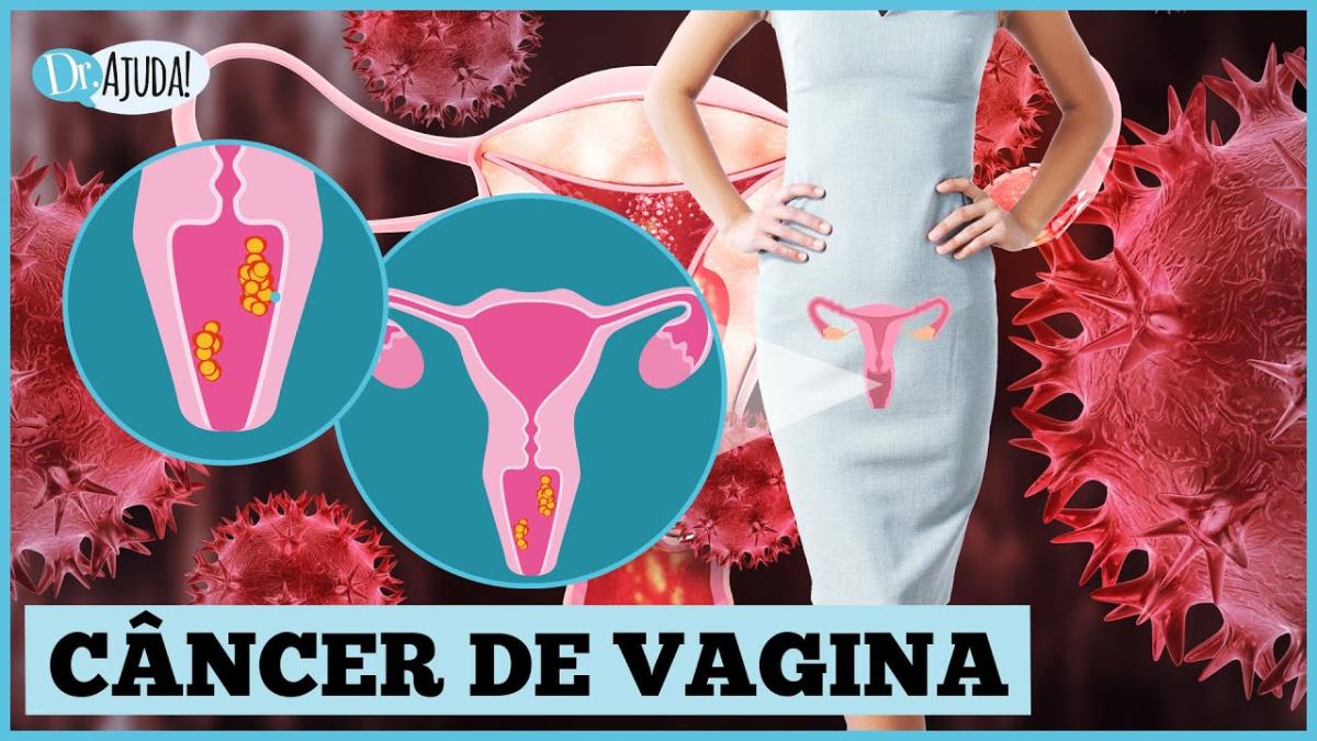 Câncer de vagina: quais o sintomas, prevenção e tratamento